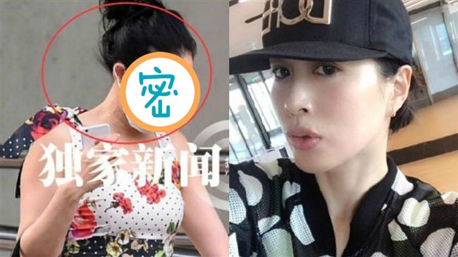 美容留嚇人針孔？鍾麗緹臉現密麻疙瘩