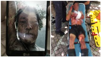 送便當遭炸傷　便當男「自拍」慘況