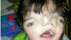 國際,英國,雙面臉男孩,臉部畸形,認知遲緩,癲癇,罕見疾病