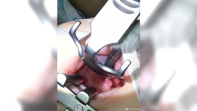 離奇！　大陸男嬰誤吞頭髮打死結