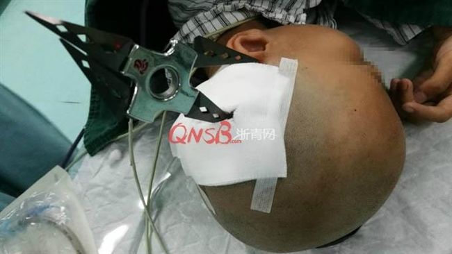 女童座位寫功課　同學射飛鏢刺穿顱骨