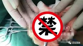 中國,大陸,睪丸扭轉,疼痛,壞死,切除(http://hainan.sina.cn/news/s/2017-06-10/detail-ifyfzfyz2915438.d.html)