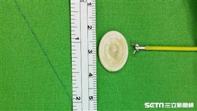 2歲劉姓男童出現吞嚥障礙，竟是誤食一枚近2公分的鈕釦。（圖／童綜合醫院提供）