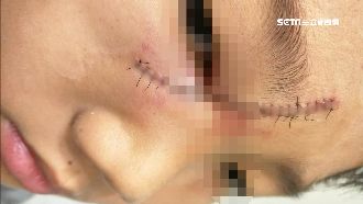 男童撿球慘摔　水管割臉破相縫25針