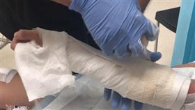 １６：９
「台灣人真幸福！」澳洲醫師爛到爆　摔斷手還要自己提醒
圖／翻攝自臉書
https://www.facebook.com/alice.lo.397501/posts/10154700997690794