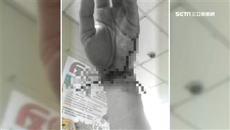 騎車突飛來鐵絲穿手腕　疑除草機釀禍