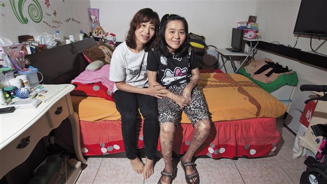 遭火吻醒來　她退成3歲童仍不忘夢想