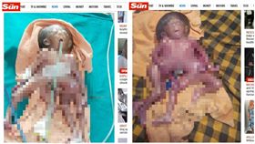 印度，女嬰，連體嬰（圖／翻攝自《太陽報》）