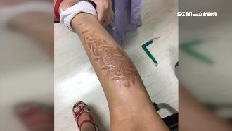 小學鐵板曬出57度　女童跌倒慘燙傷