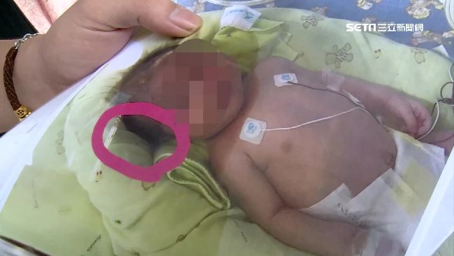 小女嬰頭骨裂　家屬控醫院疏失隱瞞
