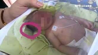 小女嬰頭骨裂　家屬控醫院疏失隱瞞