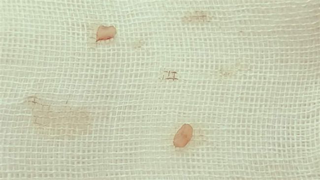 一顆疼老婆的心　老公結紮文被讚爆