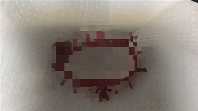 私密處拉出人形狀塑膠圈…女崩潰求救