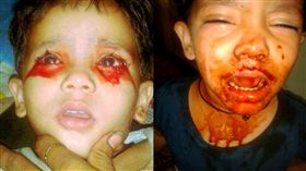 印度,罕見疾病,血汗症,阿夫札爾（Ahana Afzal） 圖／每日郵報