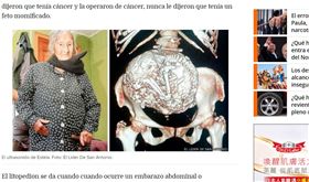 智利,阿嬤,懷孕,胎兒,石胎,鈣化,子宮,X光（圖／翻攝自EL DEBATE）
https://www.debate.com.mx/prevenir/Litopedion-el-extrano-fenomeno-del-bebe-de-piedra-20170708-0079.html