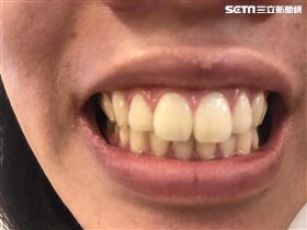 小黃車禍女乘客斷5顆牙，運將沒提醒繫安全帶被起訴。