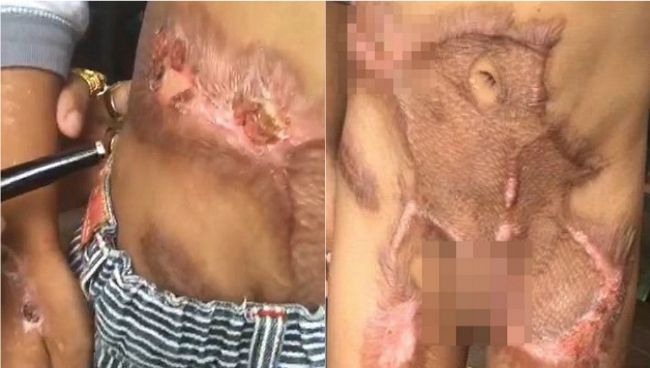 託給保母照顧　5歲男童遭燙爛下體