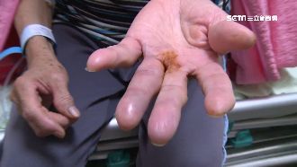 隔塑膠袋抓蜘蛛被咬　婦視力模糊昏厥