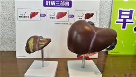 肝病三部曲，「肝炎、肝硬化、肝癌」（圖／記者楊晴雯攝）