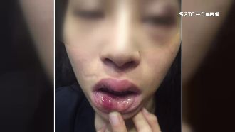不滿分手怒毆女友　女控遭打成熊貓眼