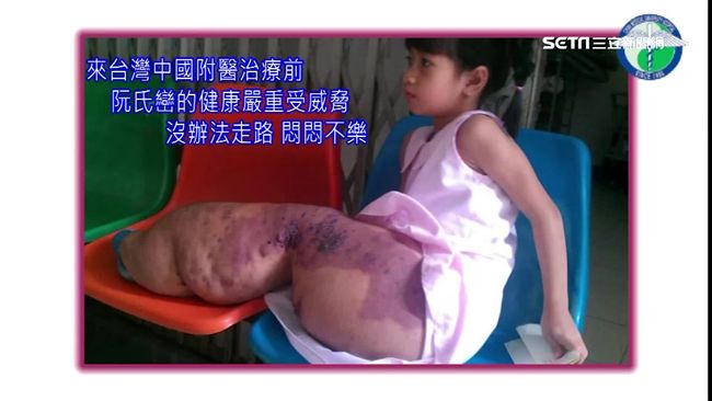 來台動刀多次　越南象腿女孩能走了
