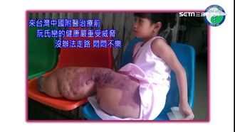 來台動刀多次　越南象腿女孩能走了