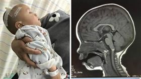 大陸,廣東,男童,竹籤,熱狗,跌倒,喉嚨,延髓,生命危險
（圖／翻攝自深圳大件事）