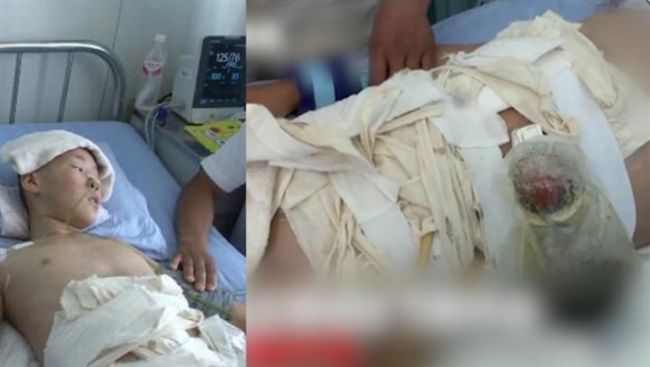 玩鞭炮炸破肚腸斷…男童奔1公里求救
