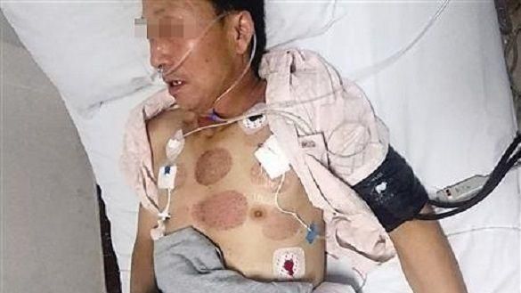 按摩店老闆無牌密醫　男子針灸刺穿肺