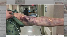 美國,亞利桑那州,傑伊,Thomas Jay,蟲,羅芙,Dee Petrov(http://www.azfamily.com/story/35970621/strange-insect-bite-turns-chandler-man-into-medical-mystery)