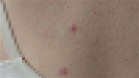 張婦背部有2處明顯紅腫傷口。（圖／翻攝畫面）