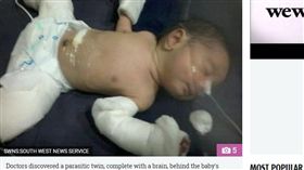 罕見「胎中胎」！印度男嬰出生已懷孕（圖／翻攝自太陽報）