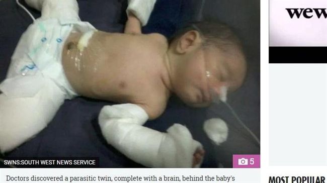 罕見「胎中胎」！印度男嬰肚中藏幼嬰