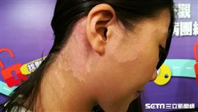 罹患乾癬的藍小姐。（圖／楊晴雯攝）