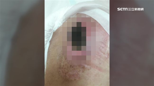 9旬失智嬤褥瘡爛到見骨　急診才發現