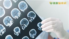 幼兒失神性癲癇　聲光刺激易發作