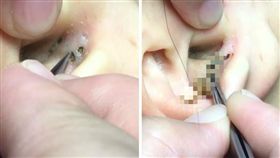 黑頭,美容,療癒,SPA,澄熒,粉刺
（圖／翻攝自澄熒SPA臉書）