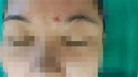 中國大陸,眉心,子彈,玩具槍,疤痕,受傷,腫塊,眼睛（圖／翻攝自杭州網） http://hznews.hangzhou.com.cn/shehui/content/2017-08/07/content_6621260.htm