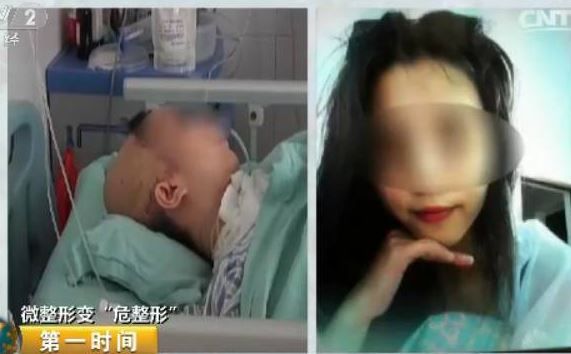 想讓太陽穴飽滿…無照診所害她變癱瘓