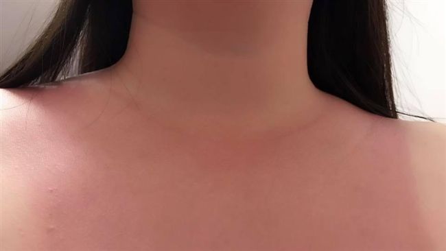 她買知名防曬乳　竟曬到如灼燒般刺痛