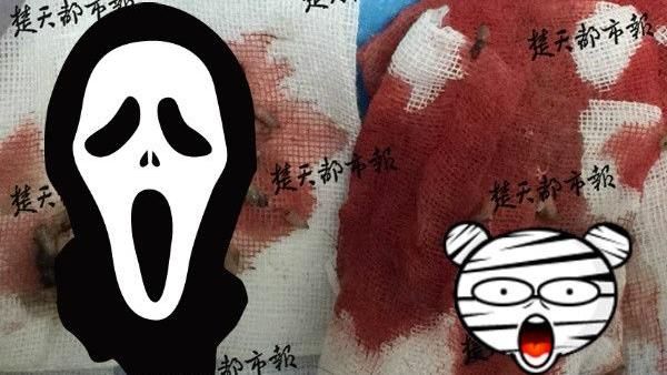 做了這動作…老翁後腦長50條蛆蟲！