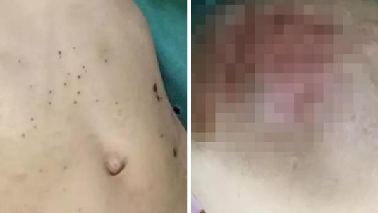 後母狠虐待　3歲女童下體流膿腐爛！
