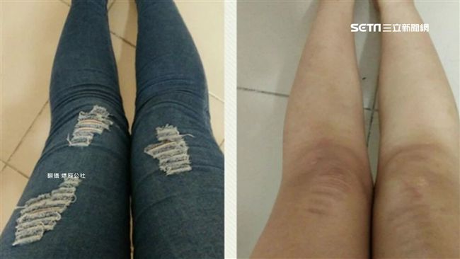 正妹穿破洞褲　大腿慘遭烈陽「紋身」