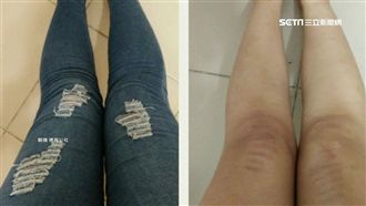 正妹穿破洞褲　大腿慘遭烈陽「紋身」