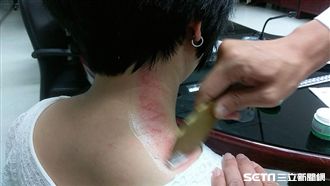 刮痧到底怎麼刮？專家叮嚀牢記2原則