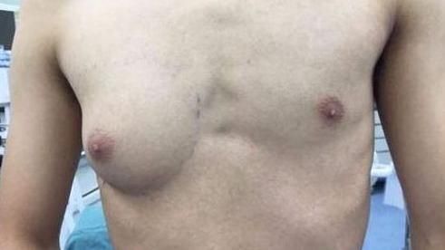 每天吃這個！19歲男變A奶乳頭如女