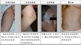 孕媽咪臉上好多斑　打雷射為何還是沒效？