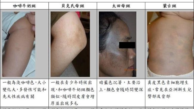 雷射除斑一定見效？聽專業醫師說分明