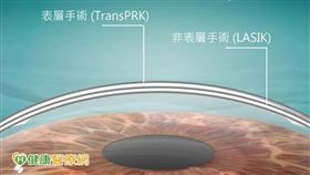 近視雷射手術夯　角膜厚度影響安全性