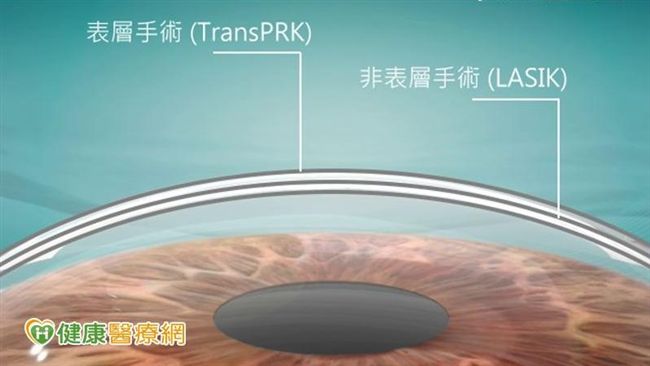 近視雷射手術夯　角膜厚度影響安全性